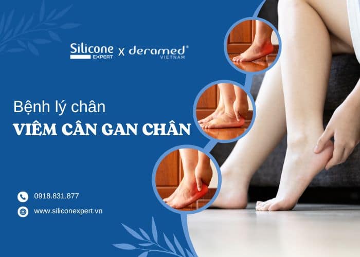 Bệnh lý Viêm cân gan chân - Căn bệnh phổ biến bị lãng quên