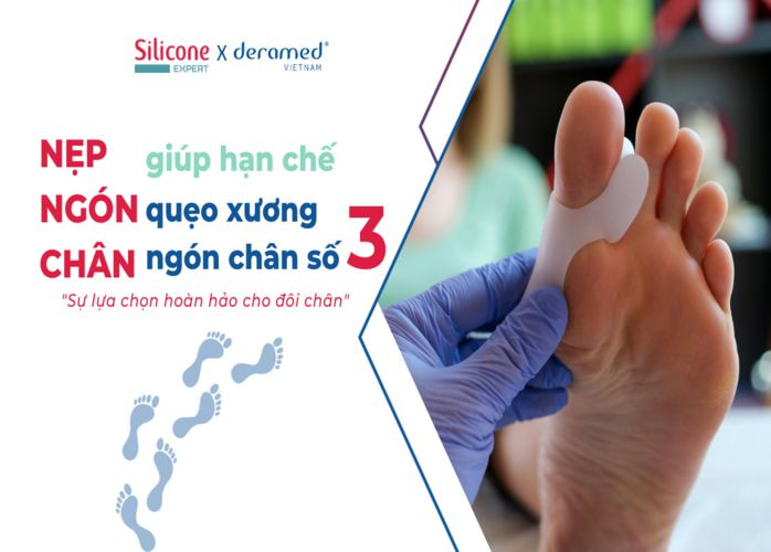 Nẹp ngón chân giúp hạn chế vẹo xương ngón chân số 3