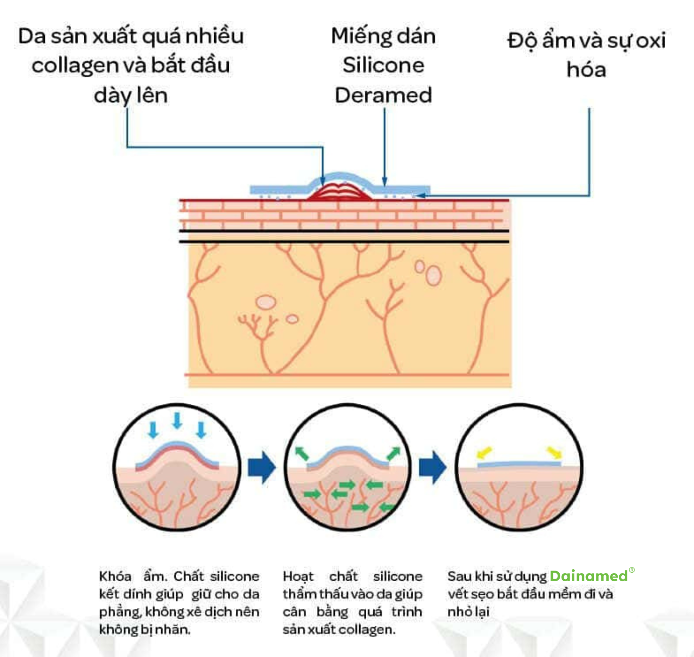 Cơ chế hoạt động tuyệt vời của Miếng dán trị sẹo sau sinh mổ.