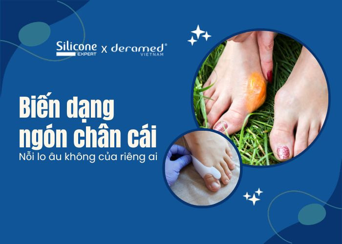 3 phương pháp điều trị biến dạng ngón chân cái từ chuyên gia