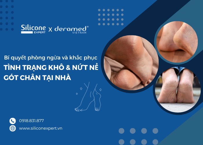 Bí quyết phòng ngừa và khắc phục khô nứt nẻ gót chân tại nhà