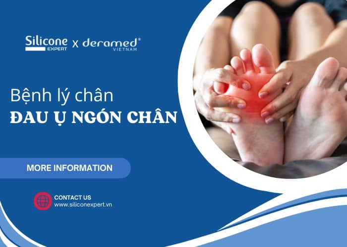 3 cách điều trị bệnh lý đau ụ ngón chân từ sản phẩm của Deramed