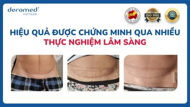 Bệnh nhân sử dụng miếng dán Deramed sau 6 tháng phẫu thuật sinh con, sau 8 tuần điều trị, sẹo cải thiện đáng kể về màu sắc và kích thước