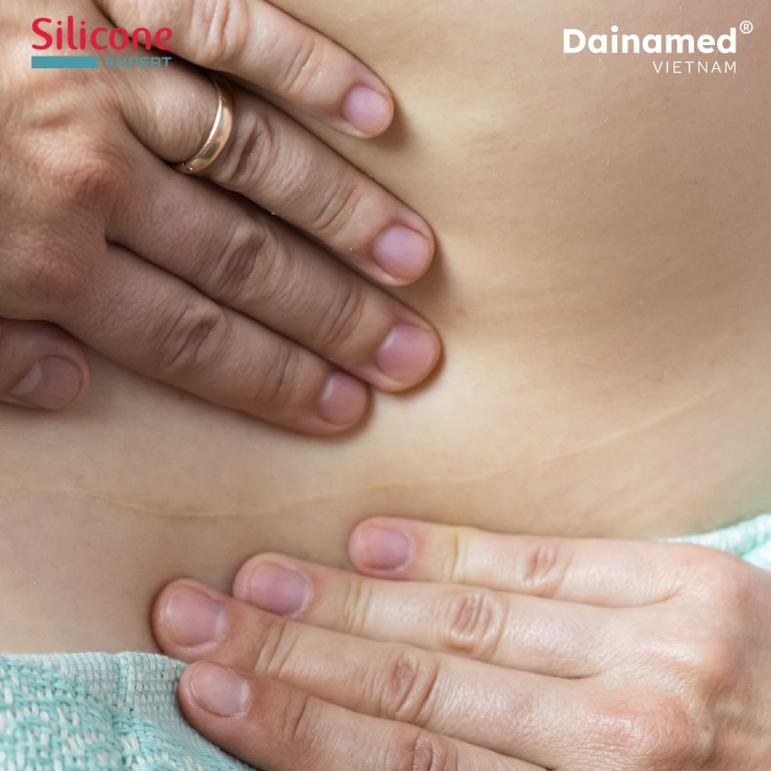 Miếng dán sẹo Dainamed giúp ngăn ngừa và mờ sẹo hiệu quả.