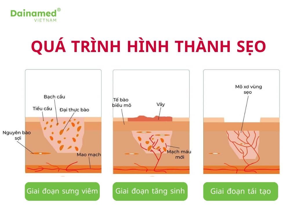 Quá trình hình thành sẹo sau phẩu thuật hoặc tai nạn, bỏng.