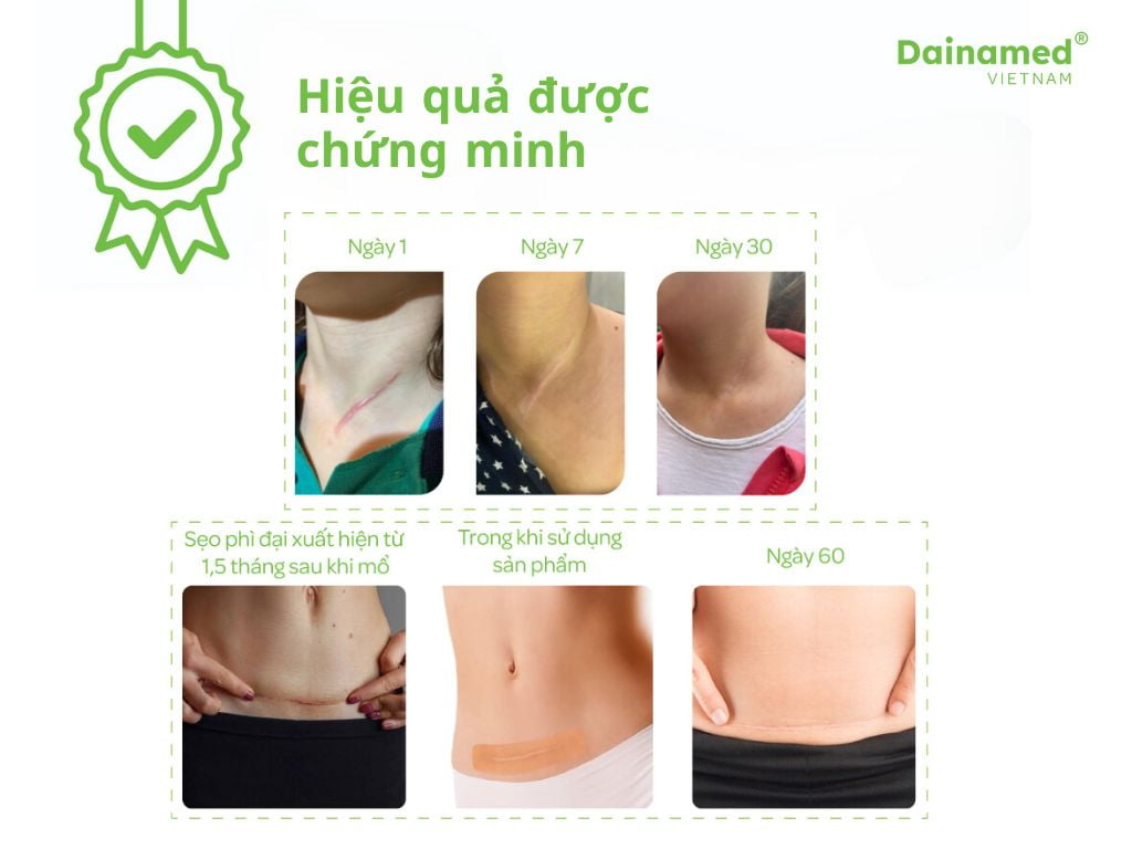 Miếng dán ngừa sẹo Dainamed được sử dụng trên các vết sẹo mổ sau sinh và vết thương ở cổ.