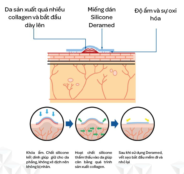 Cơ chế hoạt động tuyệt vời của Miếng dán trị sẹo sau sinh mổ.