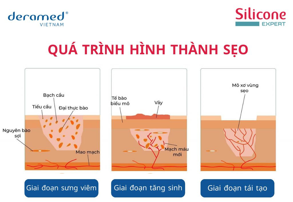 Sẹo mổ sau sinh được hình thành sau quá trình tăng sinh.